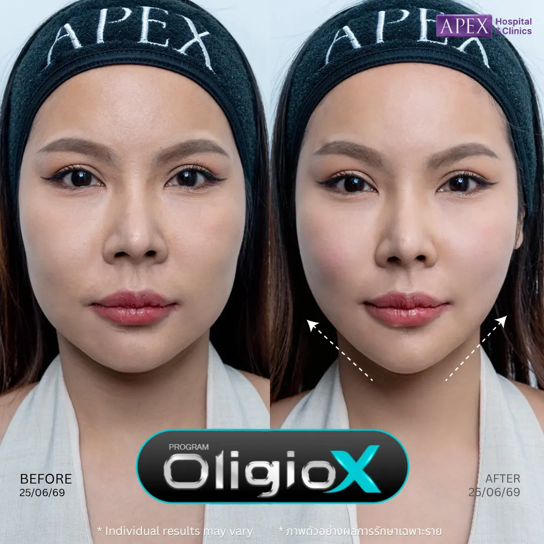 Oligio หน้าเรียว