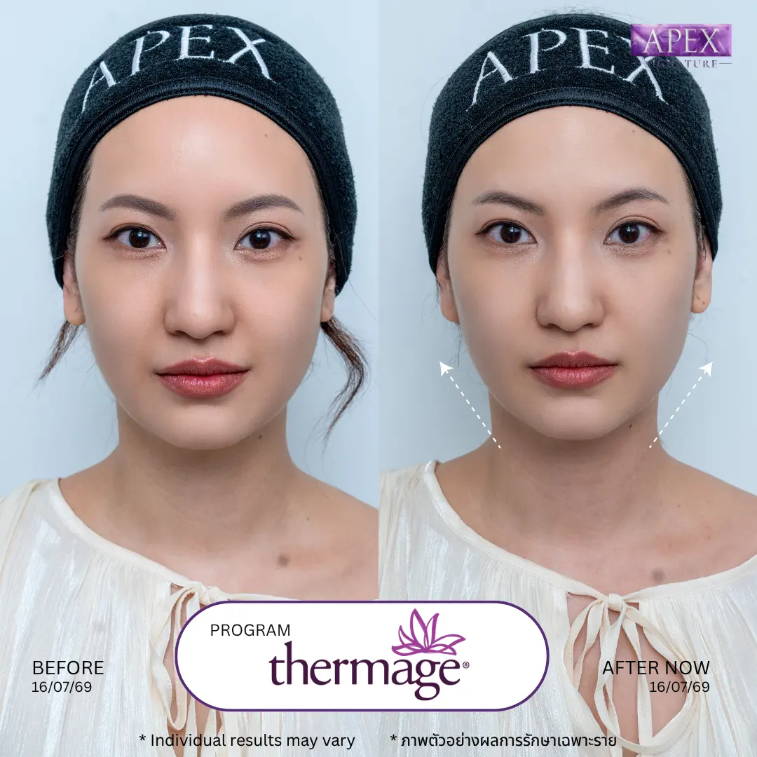 Thermage หน้าเรียว