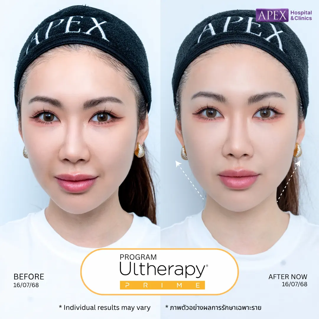 Ultherapy หน้าเรียว
