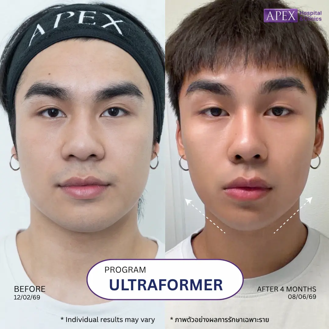 Ultraformer ปรับหน้าเรียว