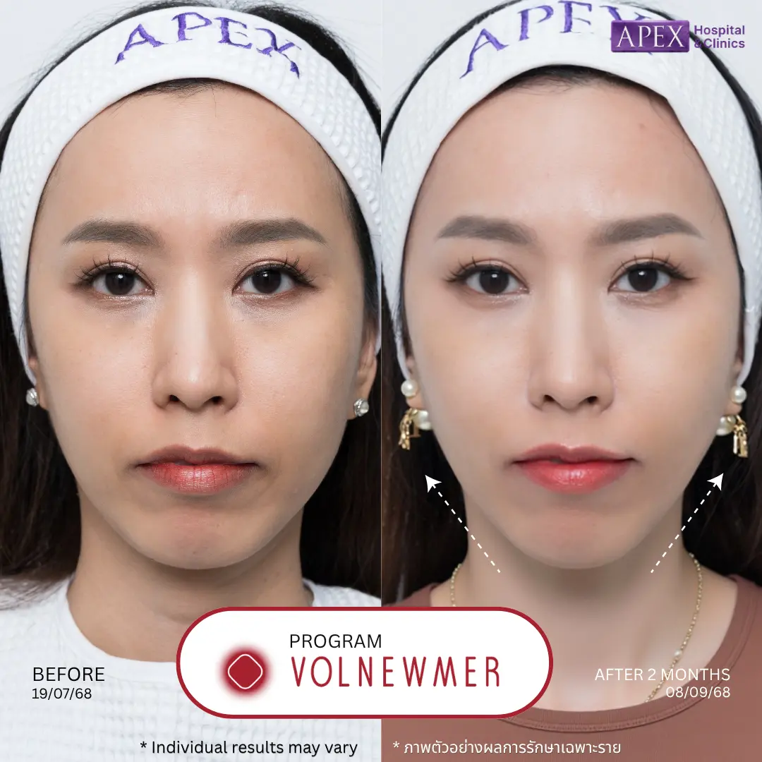 Volnewmer หน้าเรียว