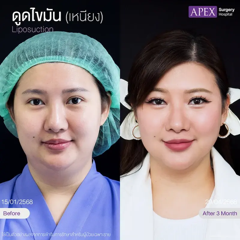 ดูดไขมันเหนียง หน้าเรียว