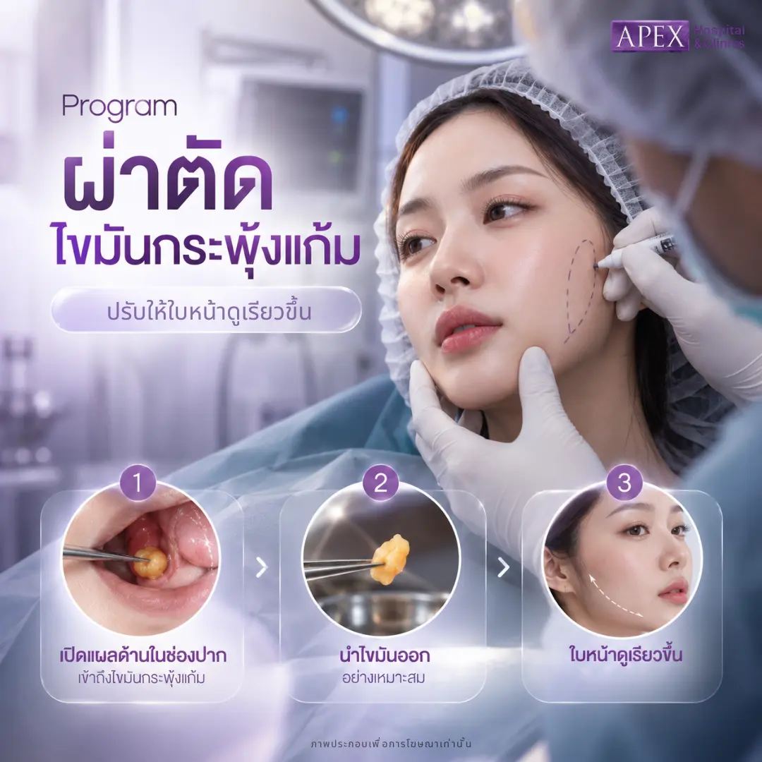 ผ่าตัดไขมันกระพุ้งแก้ม ปรับหน้าเรียว