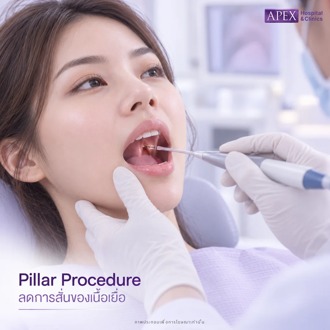 ฝัง Pillar Procedure