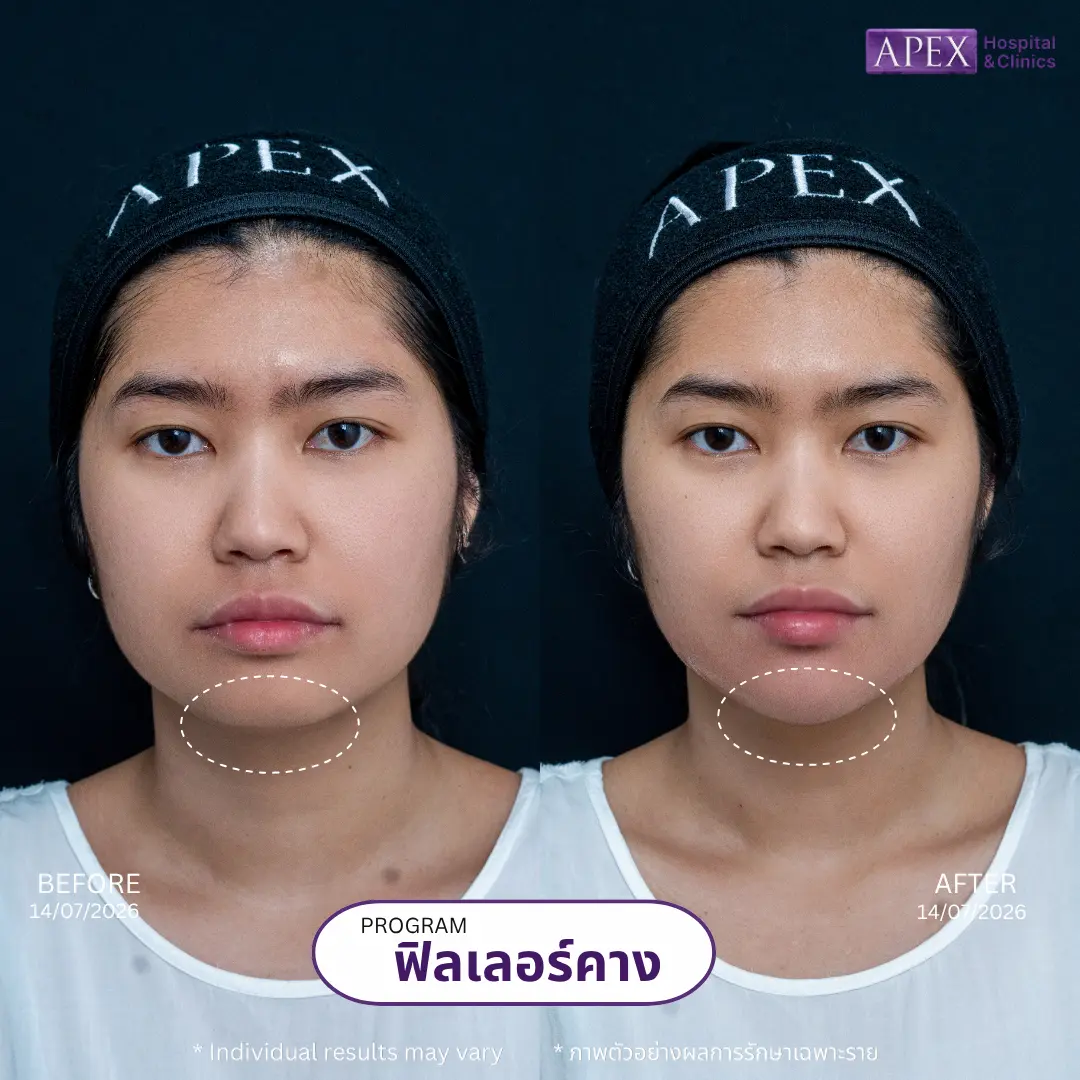 ฟิลเลอร์คาง หน้าเรียว