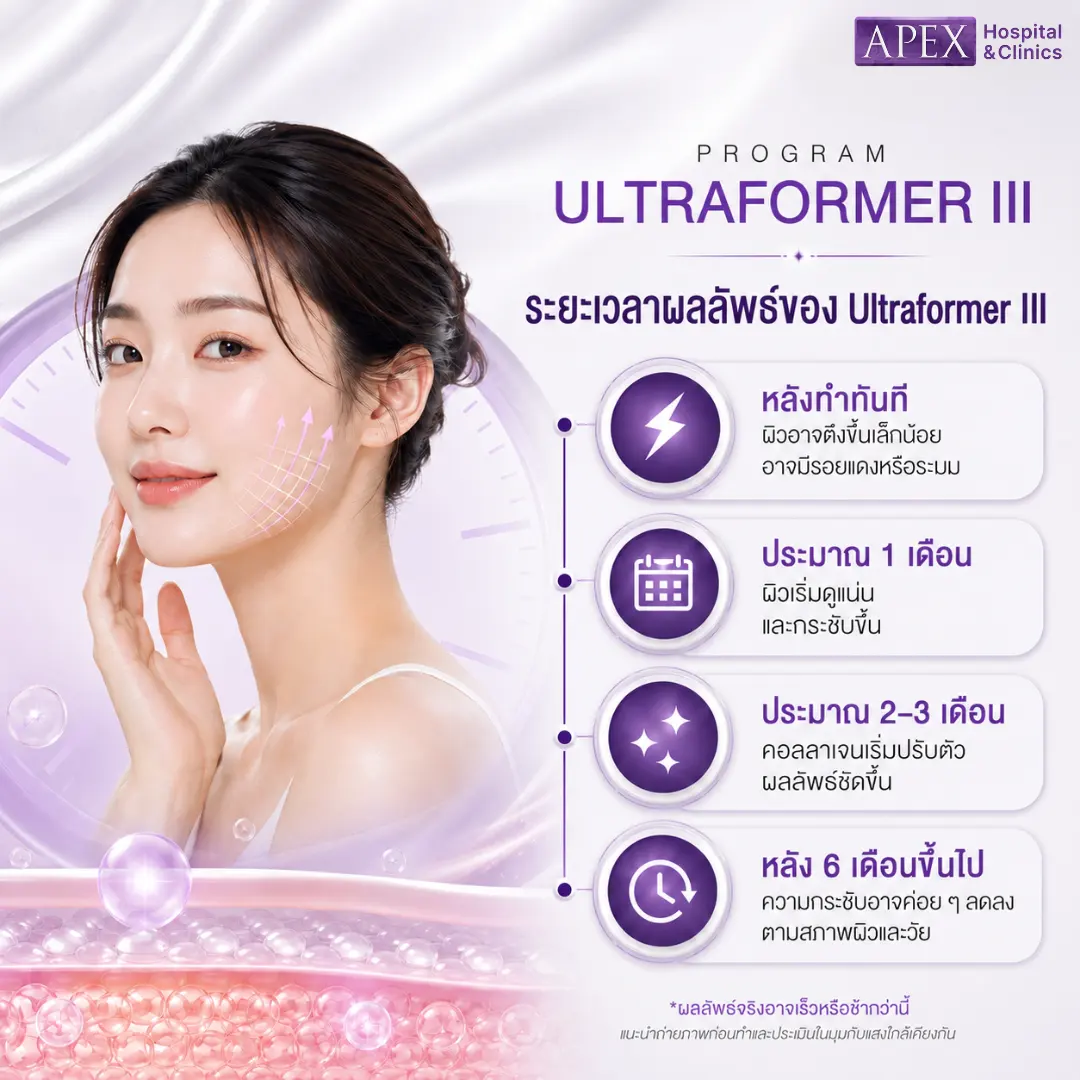 ระยะเวลาผลลัพธ์ของ Ultraformer III