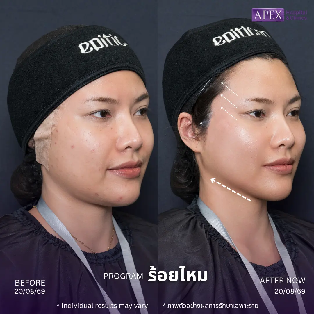 ร้อยไหม หน้าเรียว