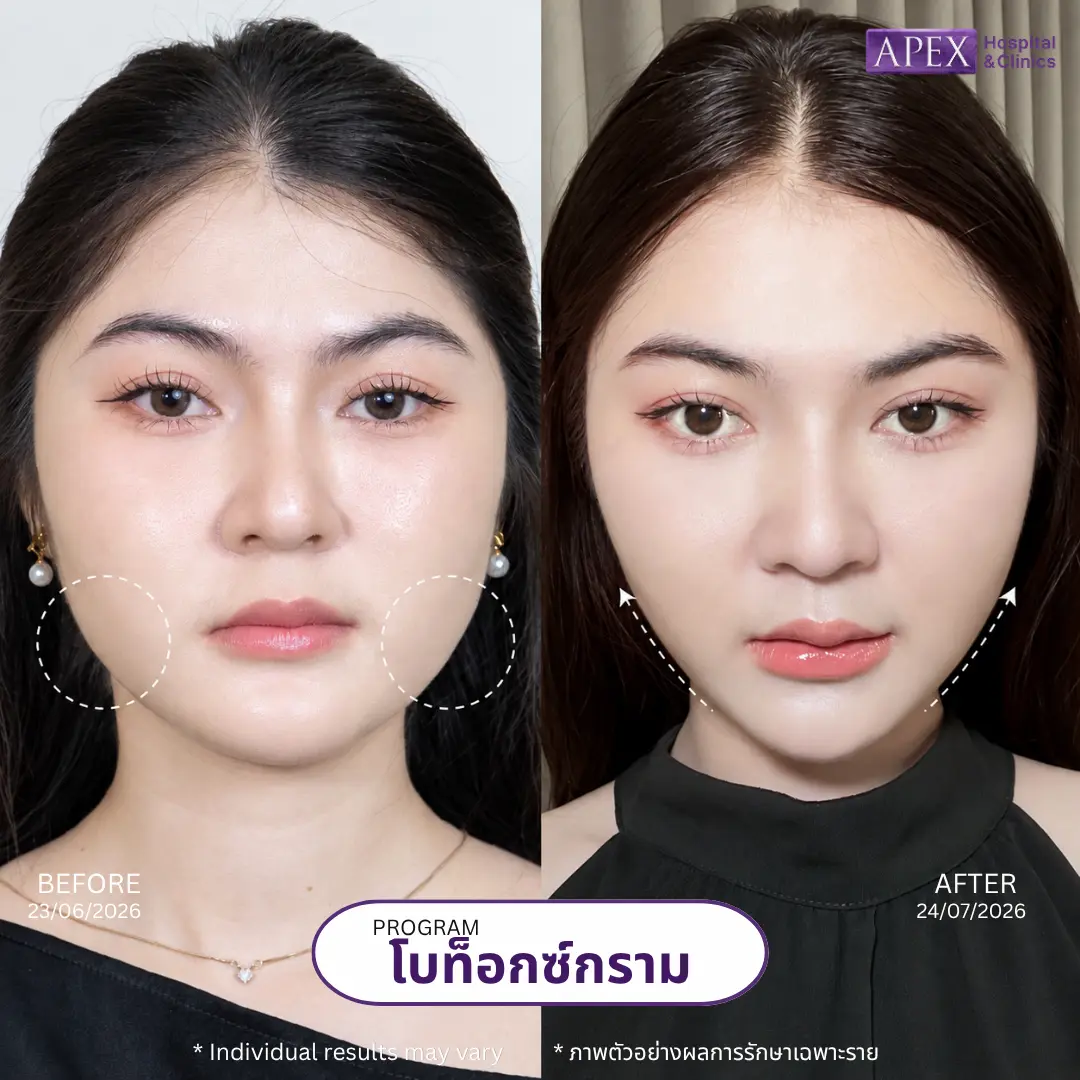 โบท็อกกราม ปรับหน้าเรียว