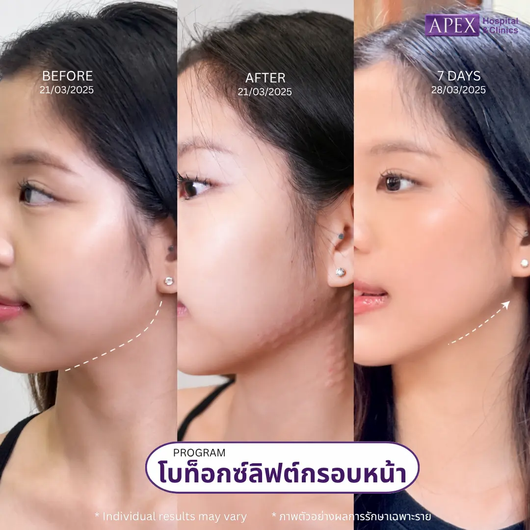 โบท็อกลิฟต์กรอบหน้า ปรับหน้าเรียว